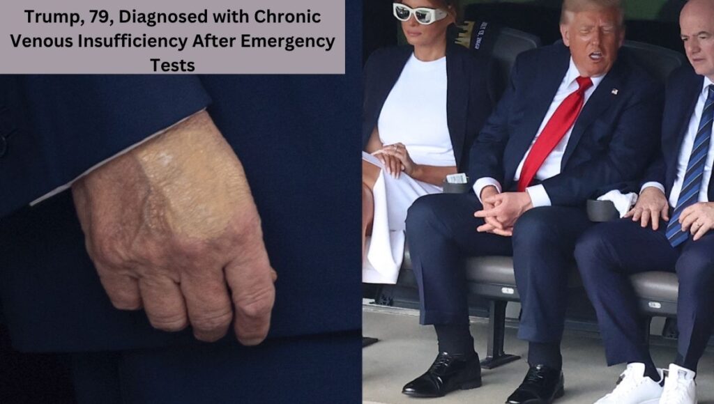Trump, 79, Diagnosed with Chronic Venous Insufficiency After Emergency Tests
