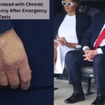 Trump, 79, Diagnosed with Chronic Venous Insufficiency After Emergency Tests Trump, 79, Diagnosed with Chronic Venous Insufficiency After Emergency Tests